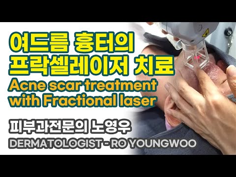 ■ 여드름 흉터의 텐셀 레이저 치료 ■ 청담오라클피부과 (acne scar treatment with tencell laser)