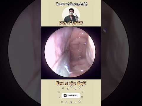 @귀지형 #콧물 #부비동염 #축농증 #비염 #코청소 #이비인후과 #rhinorrhea #rhinitis #sinusitis #asmr