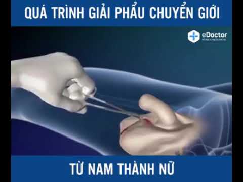 성전환수술 과정 시뮬레이션 수술영상