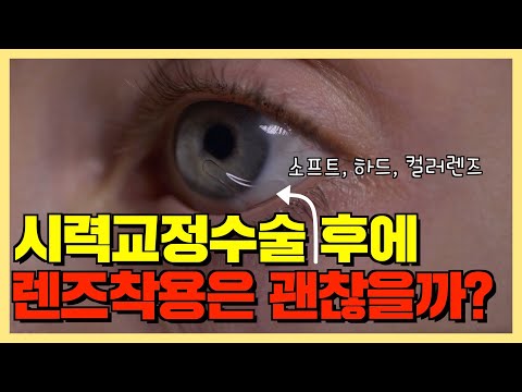 라식 라섹 후 렌즈착용 괜찮을까? | 시력교정술 | 카이안과TV