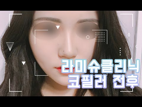 [리얼 후기] 라미슈 클리닉 닥터윤 코필러 전후
