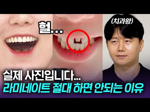 치과의사가 라미네이트 하고 싶은 당신에게 꼭! 말해주고 싶은 것 6가지