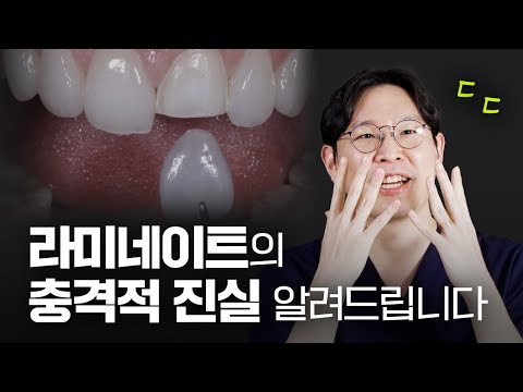 효과 만점이지만 부작용도 많은 라미네이트🦷ㅣ라미네이트의 진실! 다 밝혀드림❗️