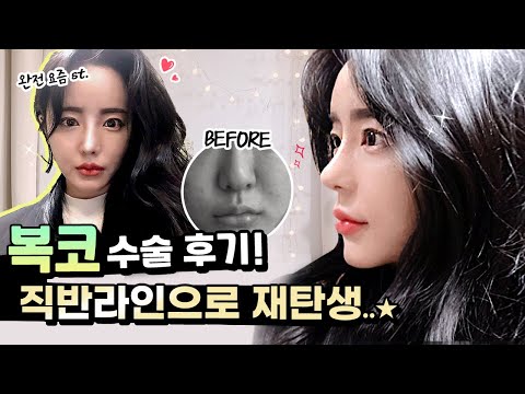 [Vlog] 딱 하나만 고치고 레전드 찍기?! 코성형후기 & 1년 경과 리뷰🤸‍♂️
