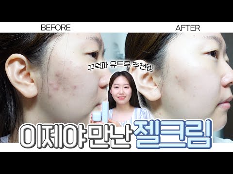 워.. 피부 변화보소..👀 드디어 젤크림 강력추천합니다💪🏻