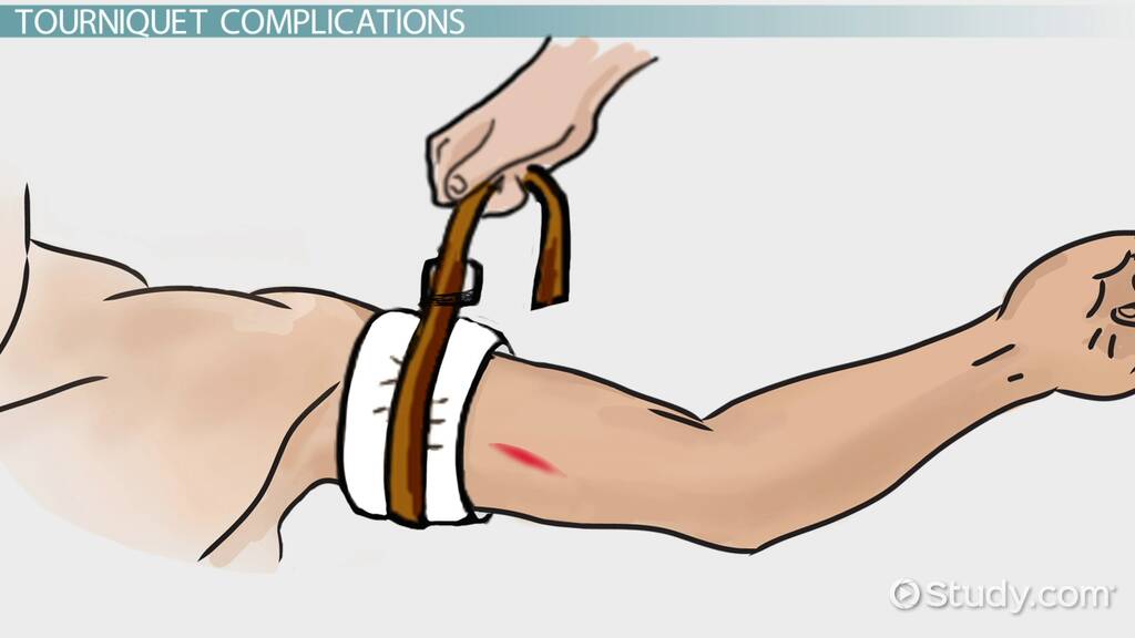 Dangers & Complications of Tourniquets - Video & Lesson Transcript | Study.com Dangers & Complications Of Tourniquets - Video & Lesson Transcript | Study.Com