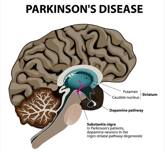 Parkinson'S Disease Pathophysiology
