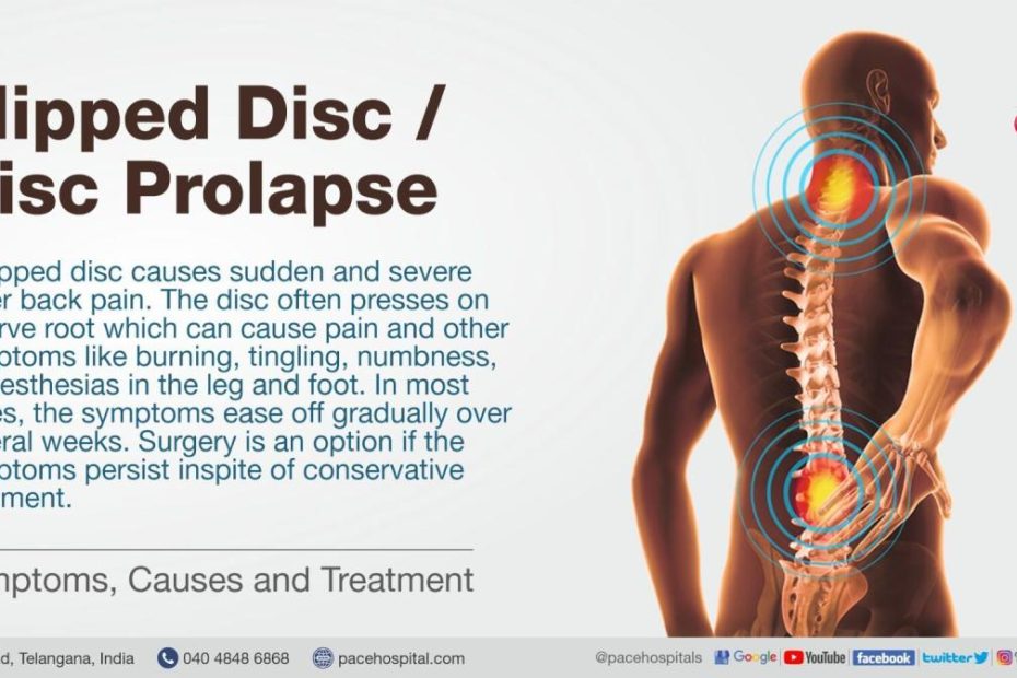 Slipped Disc Symptoms, Causes And Treatment | Disc Prolapse