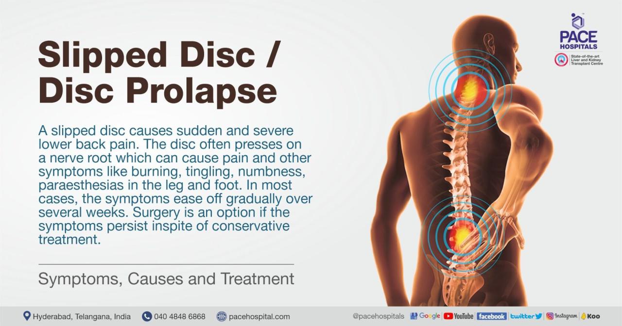 Slipped Disc Symptoms, Causes and Treatment | Disc Prolapse Slipped Disc Symptoms, Causes And Treatment | Disc Prolapse