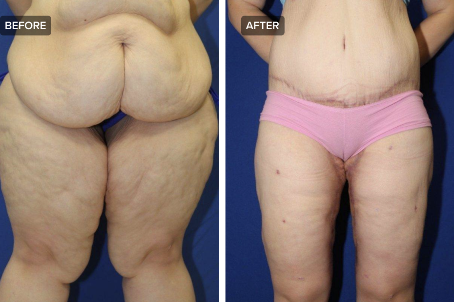 The Ultimate Thigh Lift Procedure Guide | Realself
