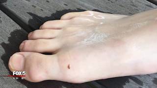 Leeches In Lake Lanier - Youtube