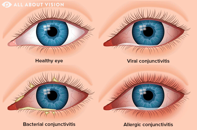 Pink Eye (Conjunctivitis) - All About Vision