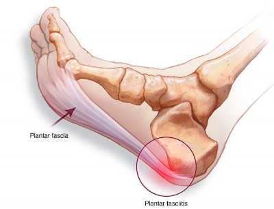 What'S Driving Your Foot Pain? — Hands On Therapeutics