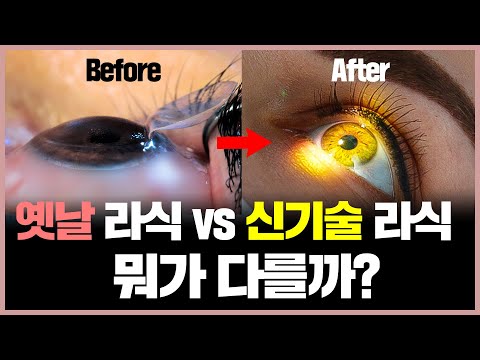[ENG SUB] 안과는 왜 가격이 비싼 최신 라식 권하는 건가요? (라식, 라섹, 스마일라식 정리)